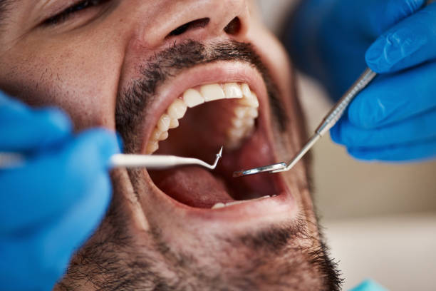 Best Emergency Wisdom Tooth Extraction in Amarillo, TX